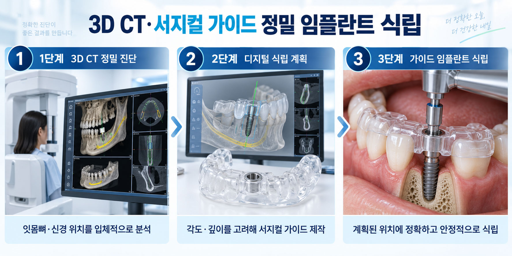 평택 디지털 임플란트 3D CT 서지컬 가이드 연세꿈꾸는치과 평택지제점